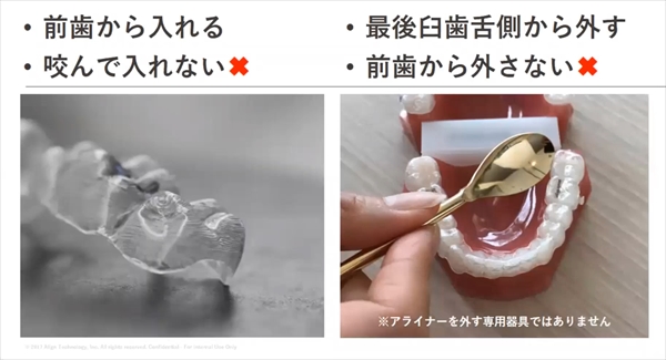 アライナーの装着と脱着法の注意点
